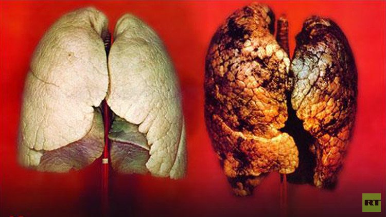 الأطباء يحددون أي المدخنين يصاب بسرطان الرئة