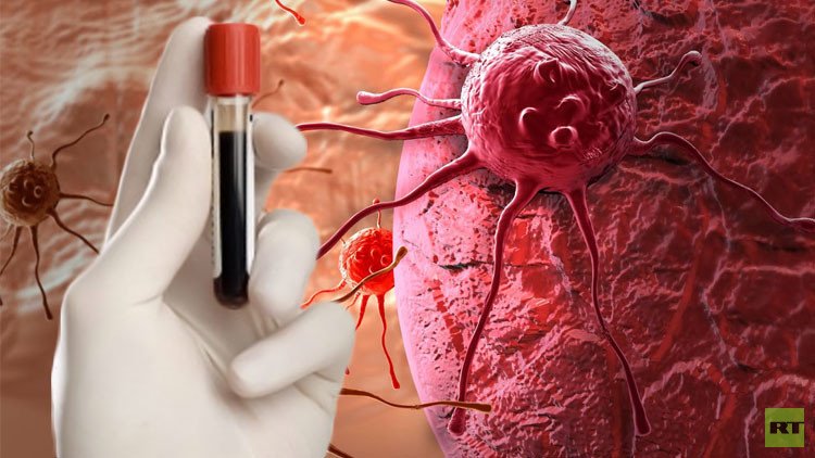 علماء روس يطورون تقنية جديدة لتشخيص مبكر للسرطان عن طريق فحص الدم