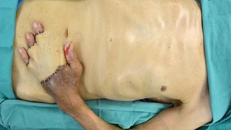عملية جراحية غريبة تنقذ يد أمريكي من البتر (صور)