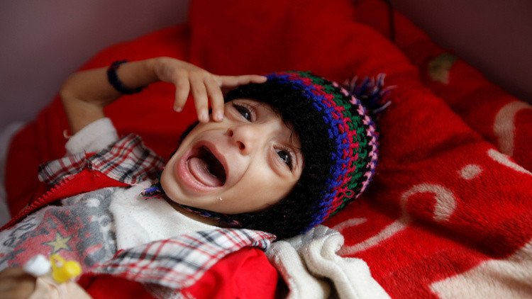 تسجيل إصابات بوباء الكوليرا في اليمن