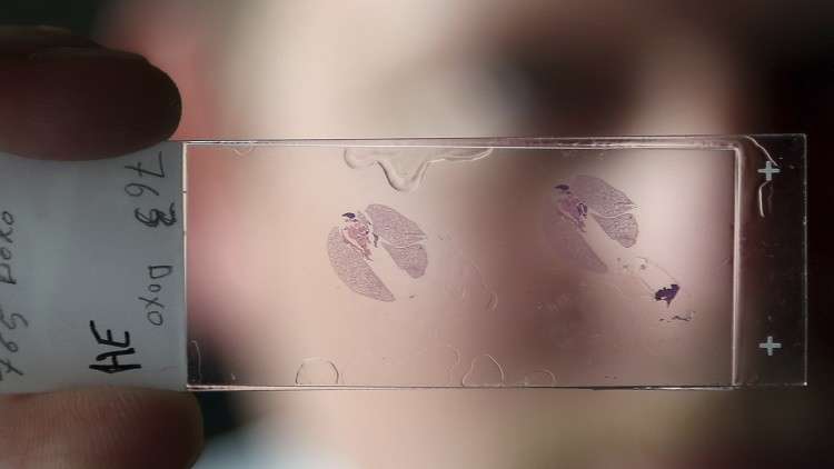 اكتشاف طريقة جديدة لتشخيص سرطان الرئة المبكر  