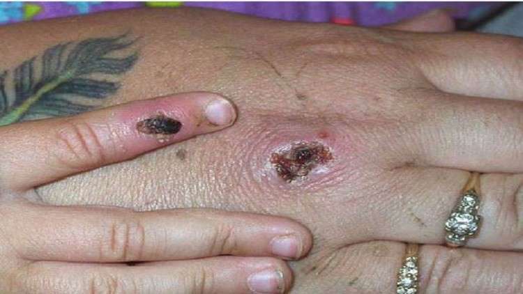 ما هو جدري القردة وما مدى خطورته على المرضى؟ 