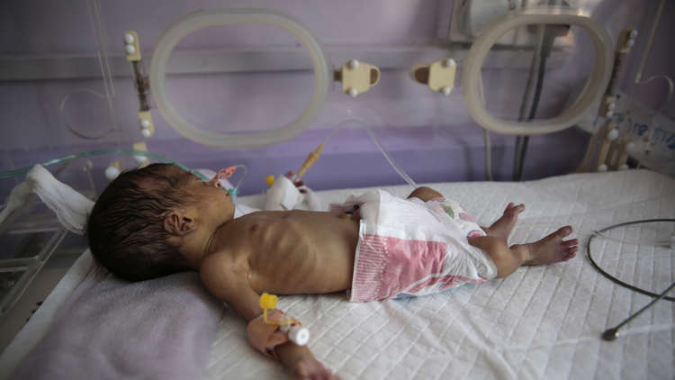 الجوع يداهم اليمن