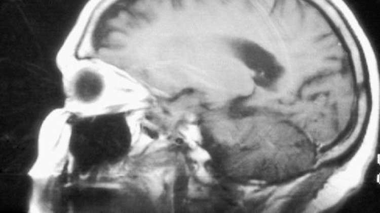 مرض يسبب إفراز الحليب من ثديي رجل كيني (صور)