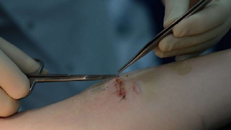 ابتكار جديد يعالج الجروح ولا يخلف ندوبا!