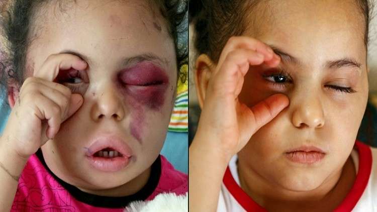 صورة عفوية مؤثرة لطفلة يمنية جعلتها أحد رموز النزاع المدمر في البلد الفقير