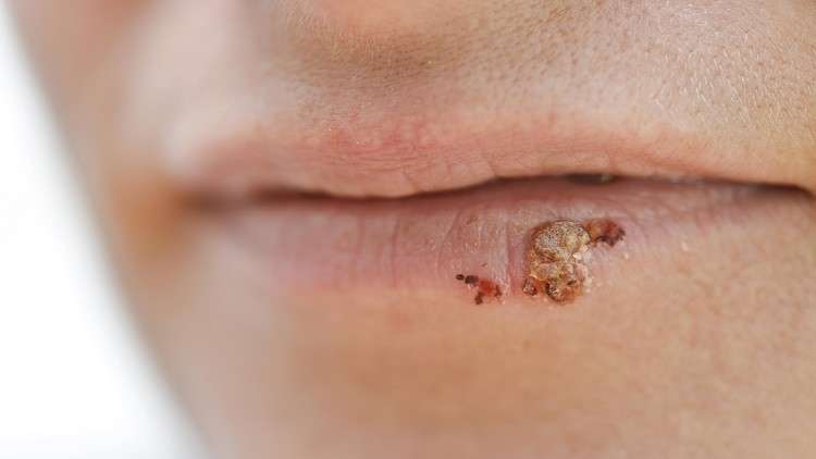 ما علاقة السرطان بفيروس الهربس؟