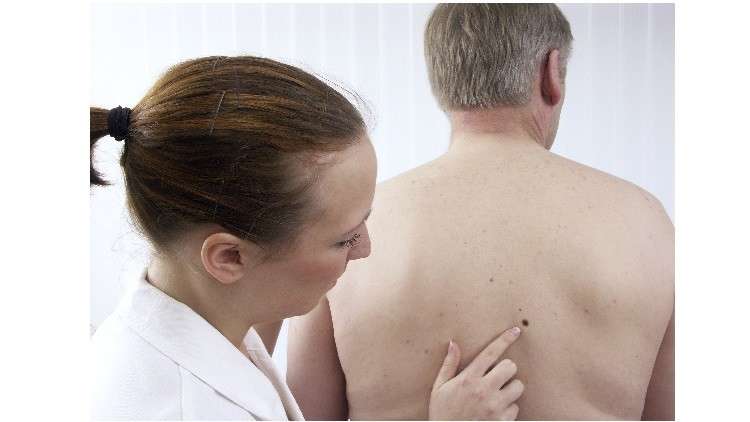 كيف نميز الشامة العادية عن الخبيثة؟