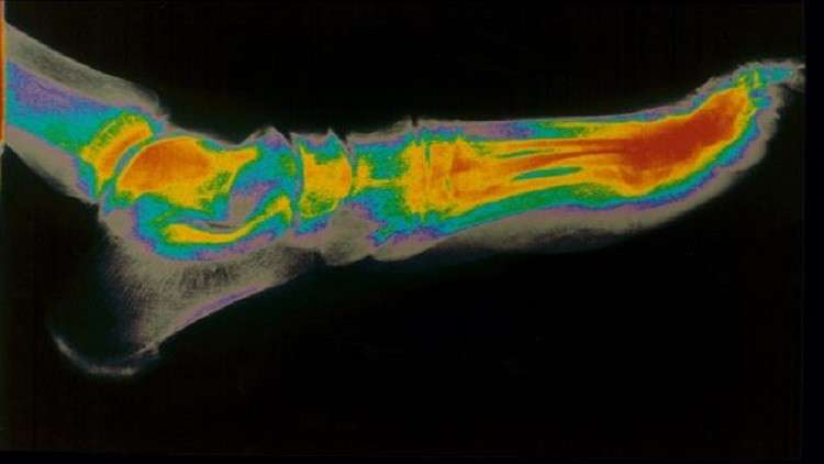 ابتكار روسي يسرّع التئام الكسور ثلاث مرات