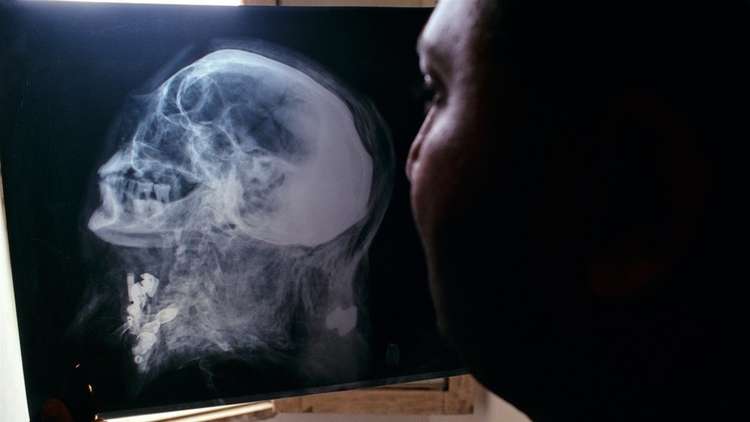 هندي ينجو من الموت بأعجوبة بعد اختراق قضيب حديدي رأسه (صورة)