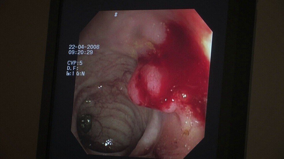 كيف نخفض من خطر "بوليب" الأمعاء؟