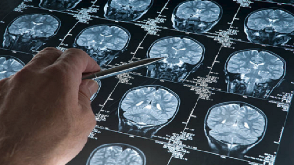 العلماء يتقدمون خطوة هامة نحو علاج مرض فقدان الذاكرة المدمر