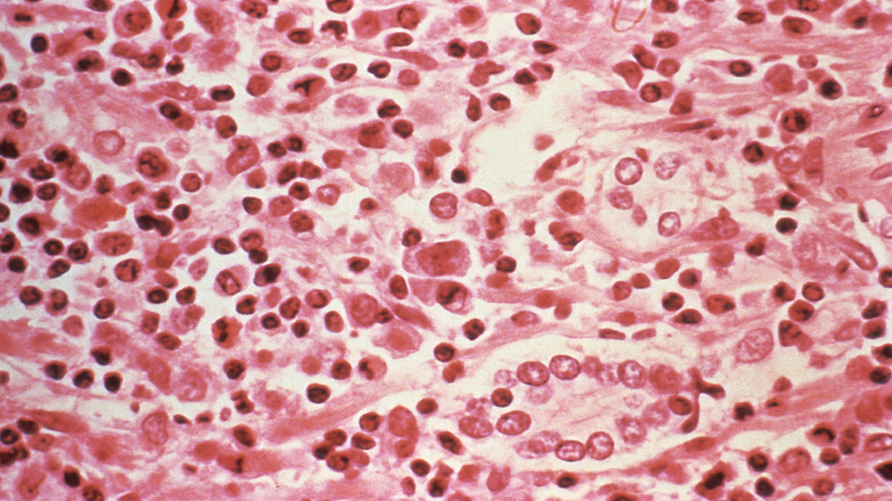 ما هو فيروس هانتا وما مدى خطورته على الإنسان؟