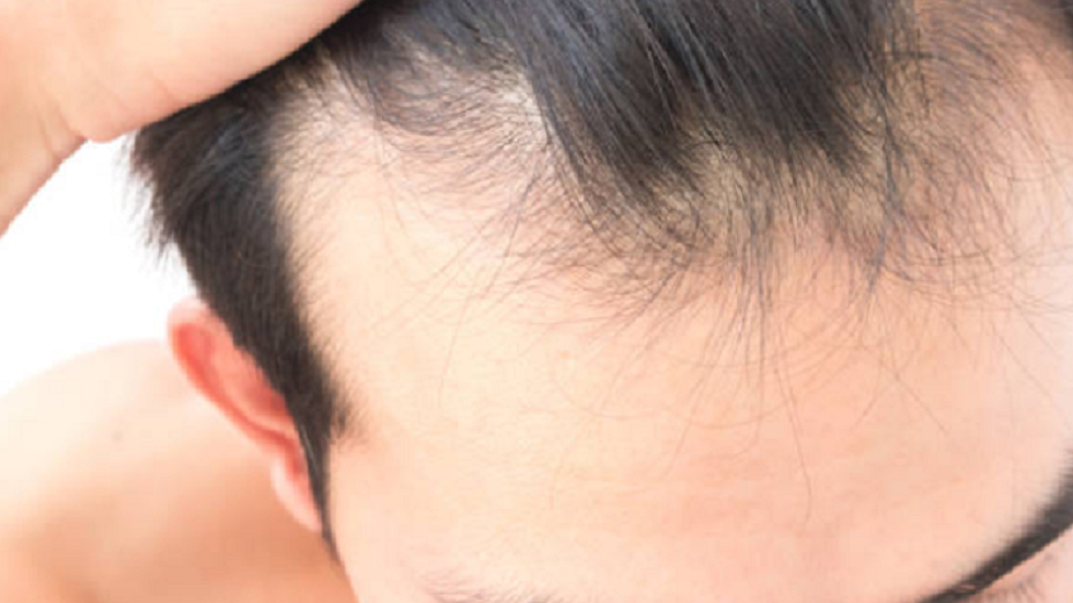 علماء يابانيون يطورون تقنية جديدة لعلاج الصلع