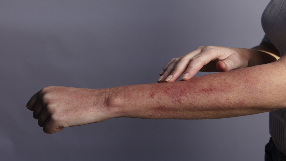 تقارير مكثفة عن أشكال من الطفح الجلدي مرتبطة بـ