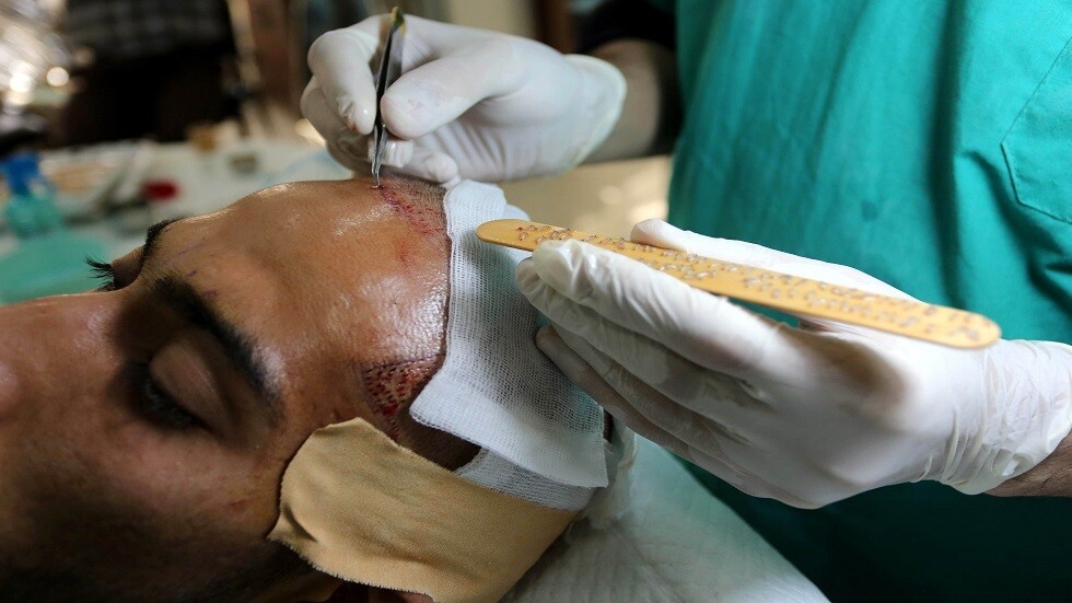 ابتكار علاج للصلع من الخلايا الجذعية