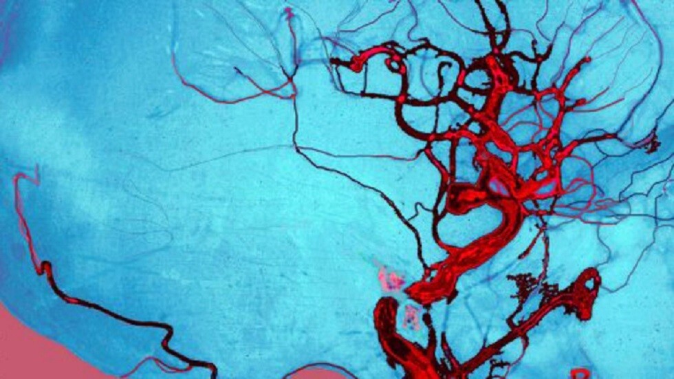 أعراض تشير إلى تمزق الأوعية الدموية