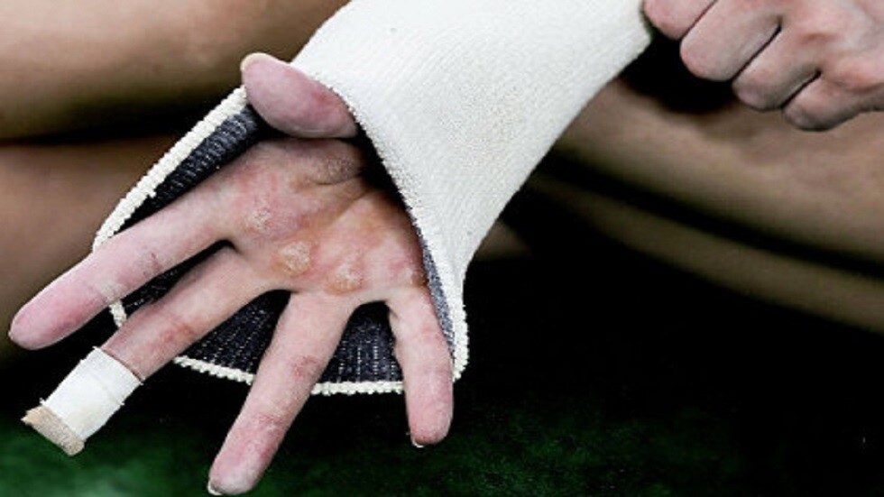 وسائل شعبية شائعة لعلاج الجسأة