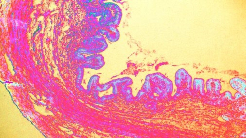 ما هو التهاب المرارة؟