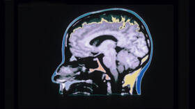 باحثون يكشفون "الأثر الحقيقي" للقلق المقترن بالاكتئاب على أدمغة المرضى!