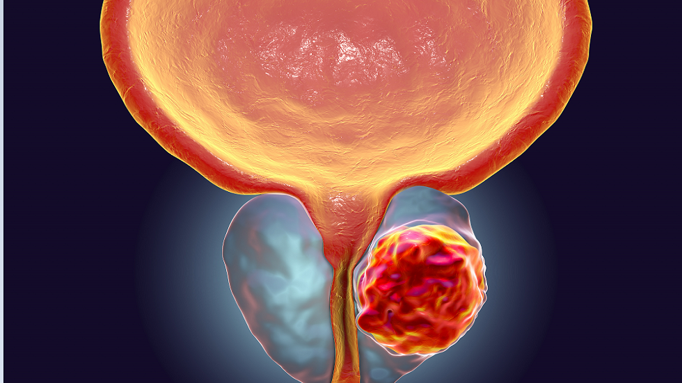 الباحثون يكشفون ما يجعل الرجال أكثر عرضة للوفاة بسرطان البروستات