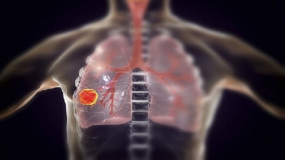 تورم في جزء معين من الجسم قد يدل على الإصابة بسرطان الرئة!