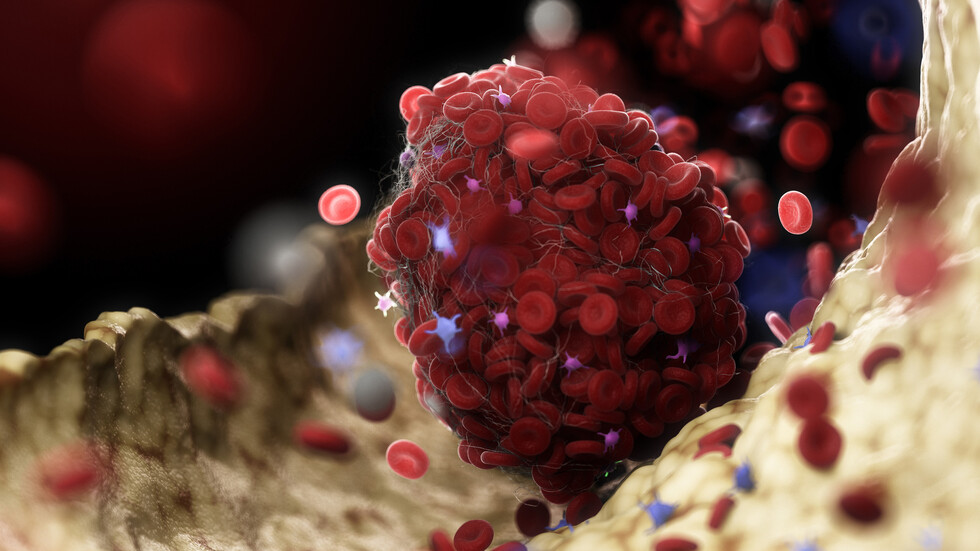 تحديد سبب جديد لجلطات الدم في حالات 