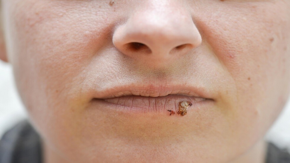 نزلات البرد تصبح خطرة بسبب الهربس الخبيث