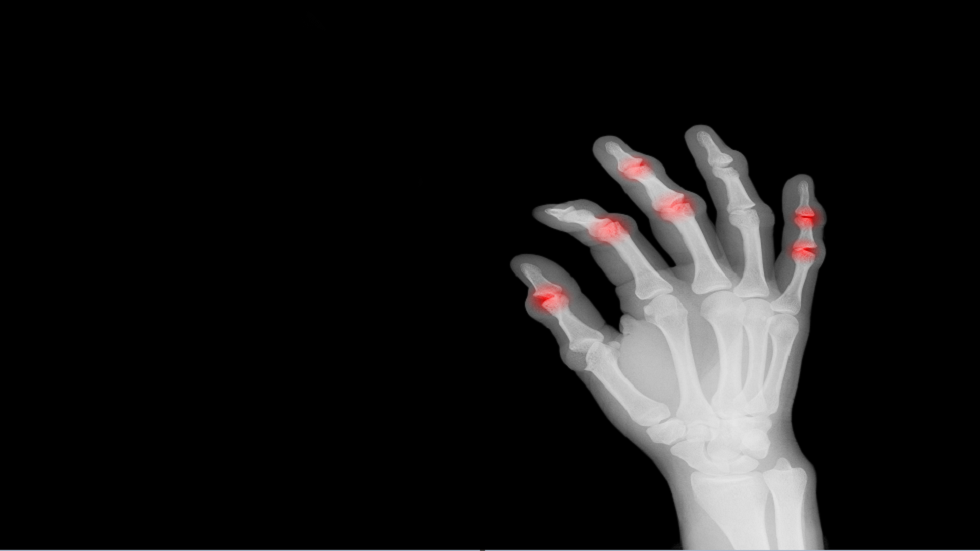 علامة التحذير الدقيقة في أصابعك  لالتهاب المفاصل الروماتويدي!
