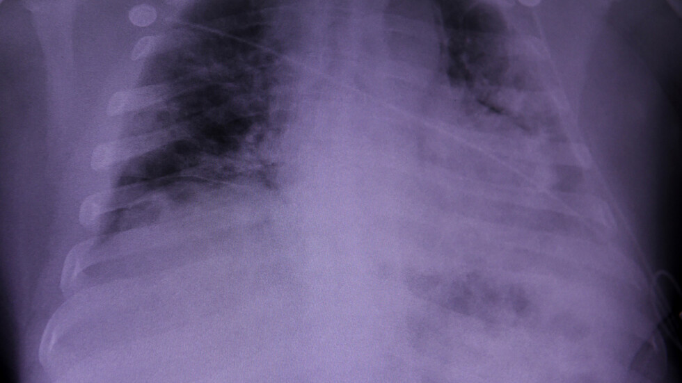 كورونا وسرطان الرئة.. التشابه والاختلاف