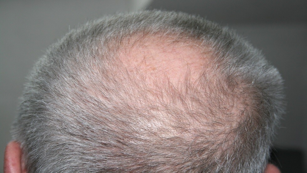 كشف طريقة لمنع الصلع