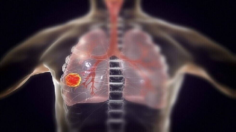 خمس علامات غير معروفة لمرض سرطان الرئة المهدد الحياة