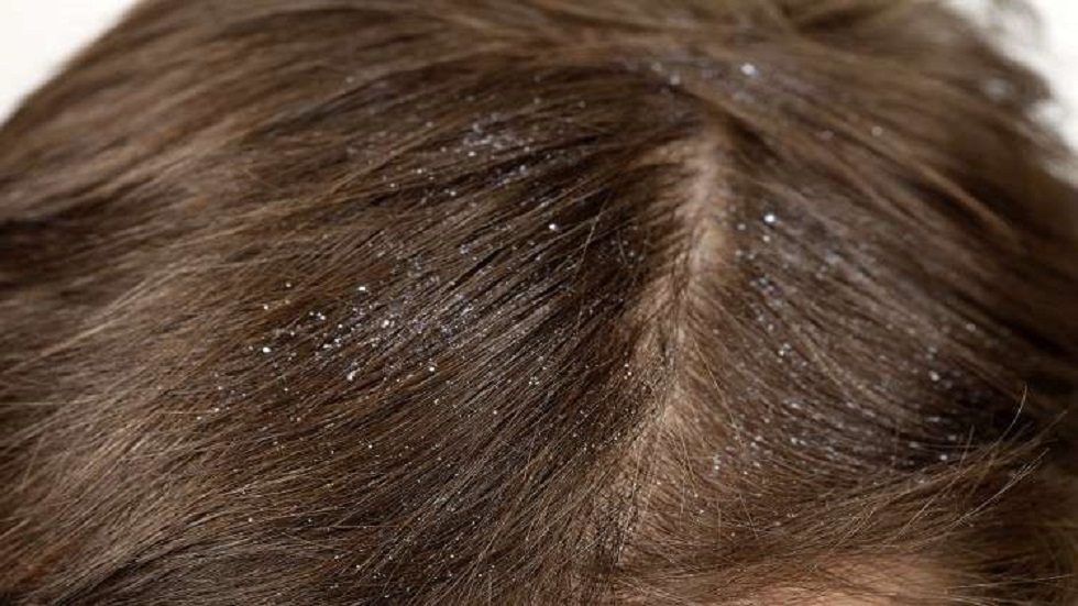 احذر!.. قشرة شعر الرأس قد تكون علامة مرض خطير