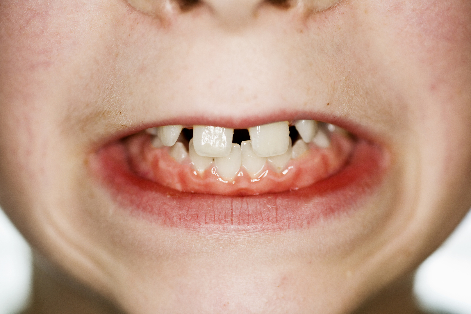 لماذا يطور البعض فراغات بين أسنانهم؟