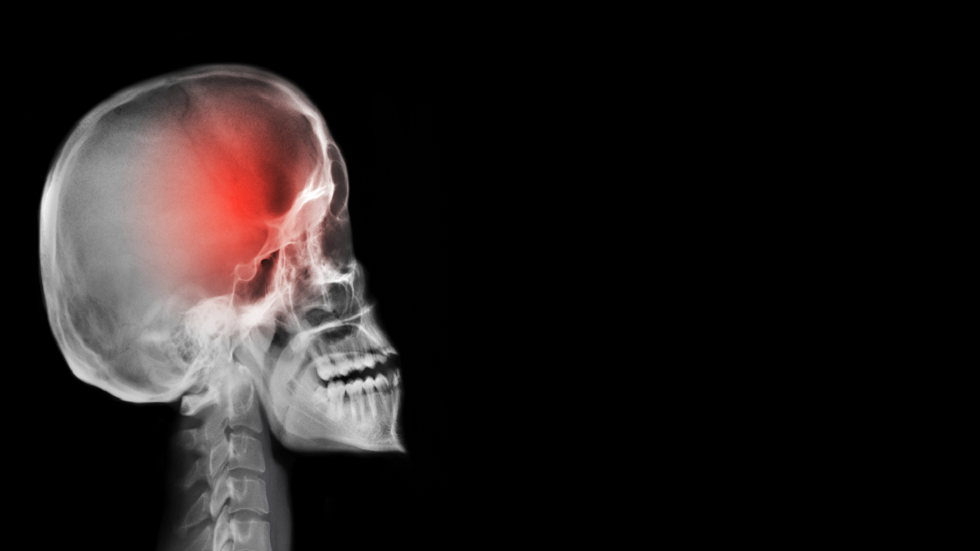 عملية الشفاء من السكتة الدماغية قد تؤدي إلى مرض قاتل!