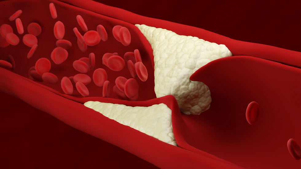 علامة تحذير على مؤخرة رأسك لأعراض ارتفاع الكوليسترول الخطير!