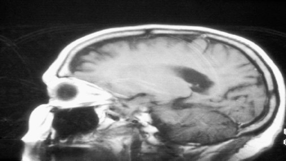 نتائج واعدة لاختبار أول لقاح مضاد لسرطان الدماغ