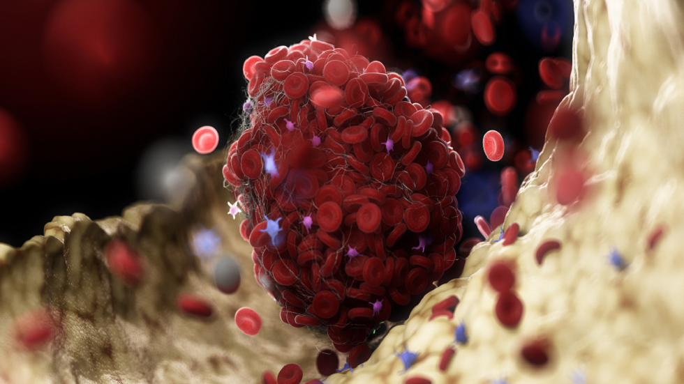 ما هو خثار الجيب الوريدي المخي الذي أصاب 6 نساء بعد لقاح 