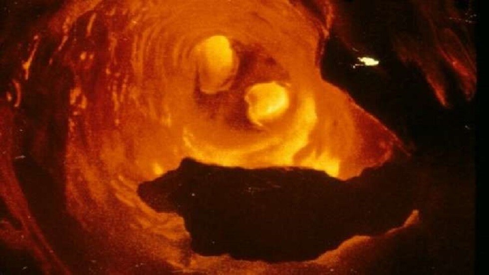 الأشخاص الأكثر عرضة للإصابة بتصلب الشرايين