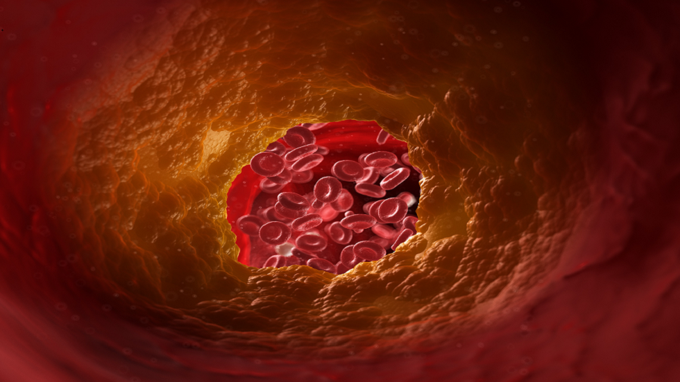 3 أعراض على اليدين والجلد والعينين تنذر بمخاطر ارتفاع نسبة الكوليسترول في الدم