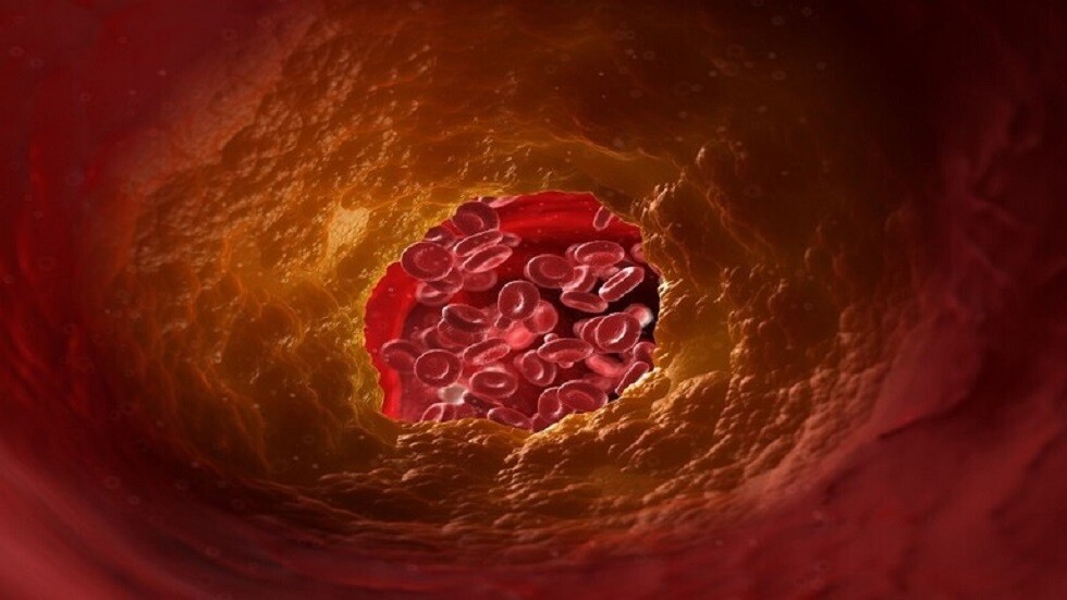 اكتشاف خطر جديد لارتفاع مستوى الكوليسترول في الدم