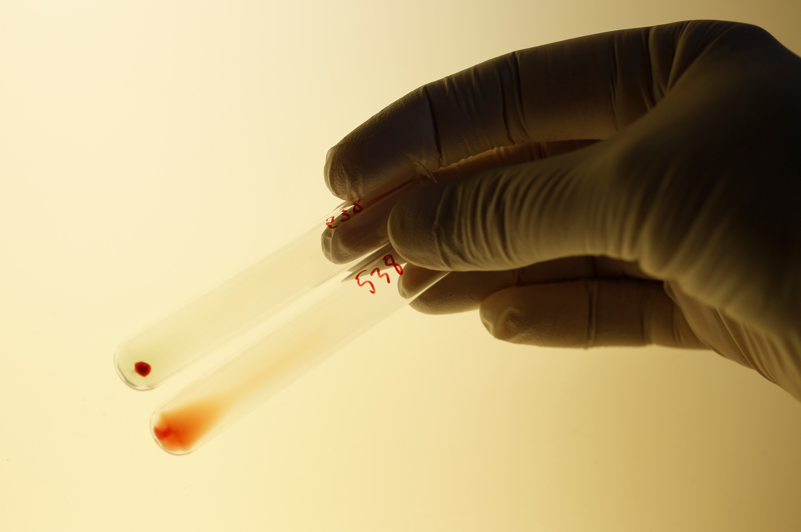 علماء  يكتشفون علاقة بين أمراض خطيرة ونوع فصيلة الدم