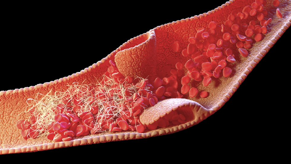 دراسة تحدد سبب تشكّل جلطات الدم لدى المصابين بـ