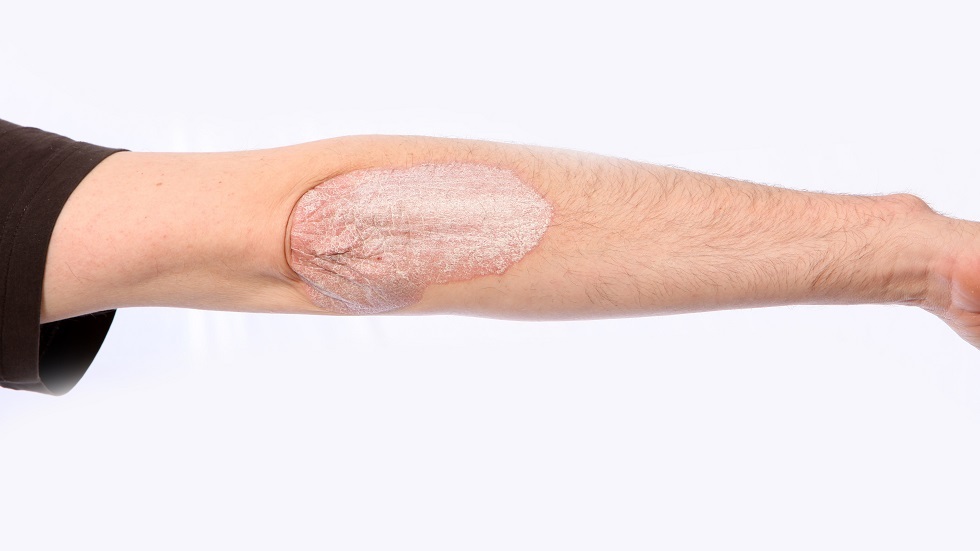 تشقق جلد المرفقين يشير إلى أمراض معينة