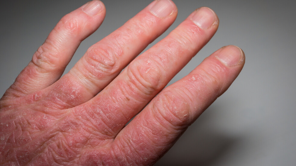 أطعمة محددة يمكنها إدارة شدة وتواتر أعراض مرض التهابي مزمن يصيب المفاصل