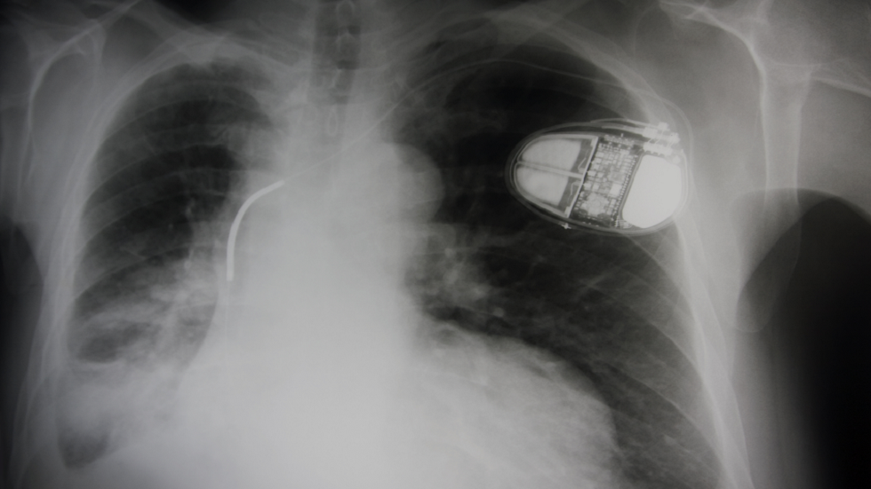 تطوير جهاز تنظيم ضربات القلب خال من البطاريات!