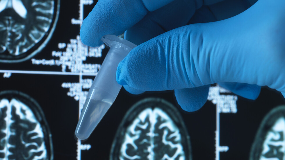 علماء يكتشفون شكلا نادرا وخطيرا من مرض ألزهايمر يبدأ مطلع الأربعينات