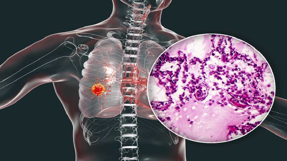 10 تغيرات في الجسم قد تكون علامات منذرة بسرطان الرئة