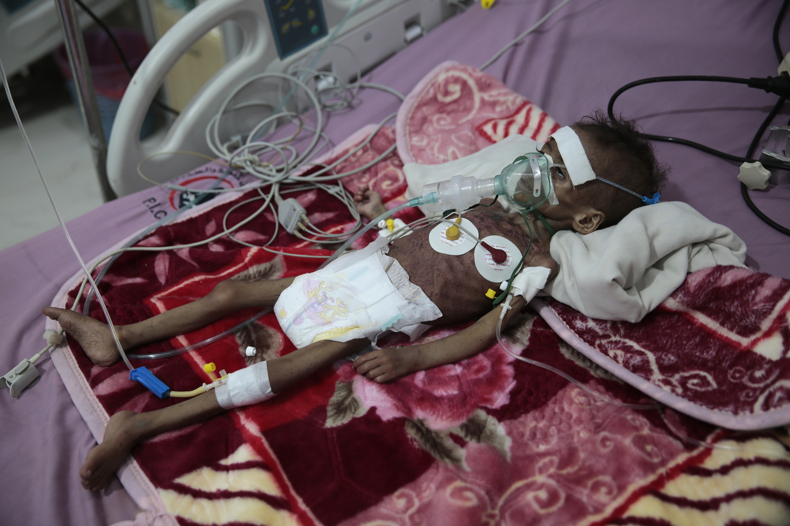 الأمم المتحدة: 16 مليون يمني يسيرون نحو المجاعة