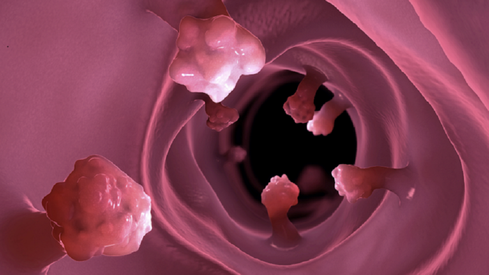 دراسة تجد مؤشرا محتملا جديدا لسرطان الأمعاء!